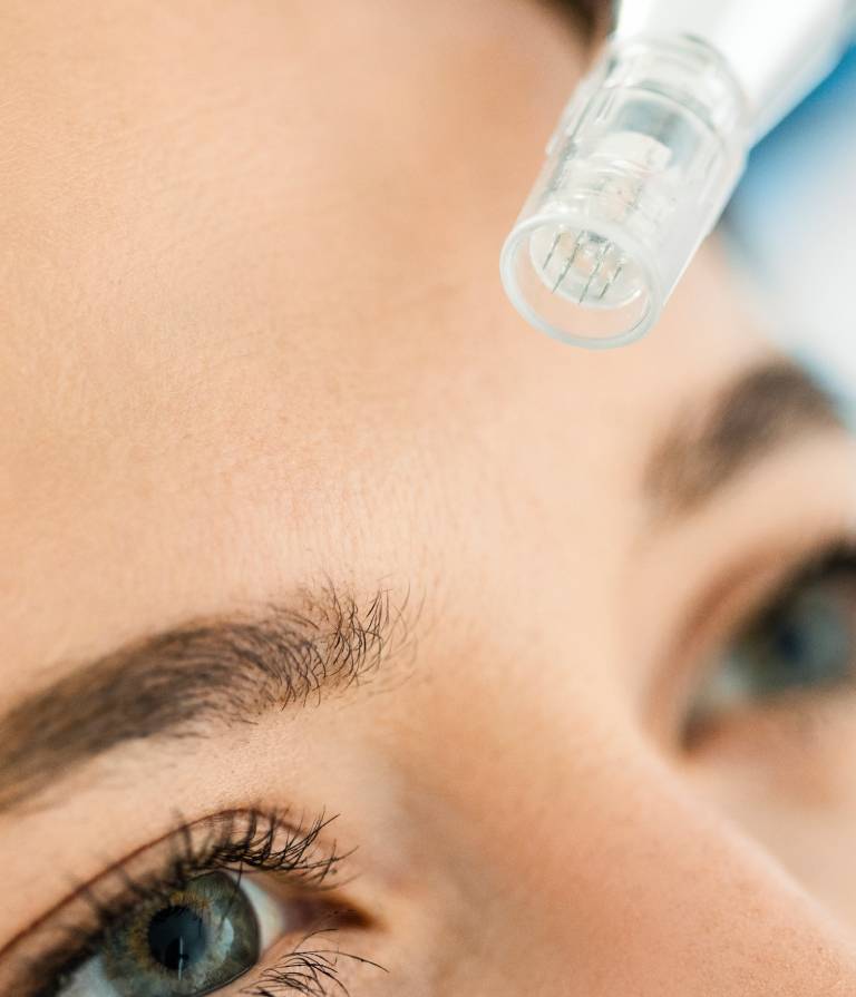 Microneedling